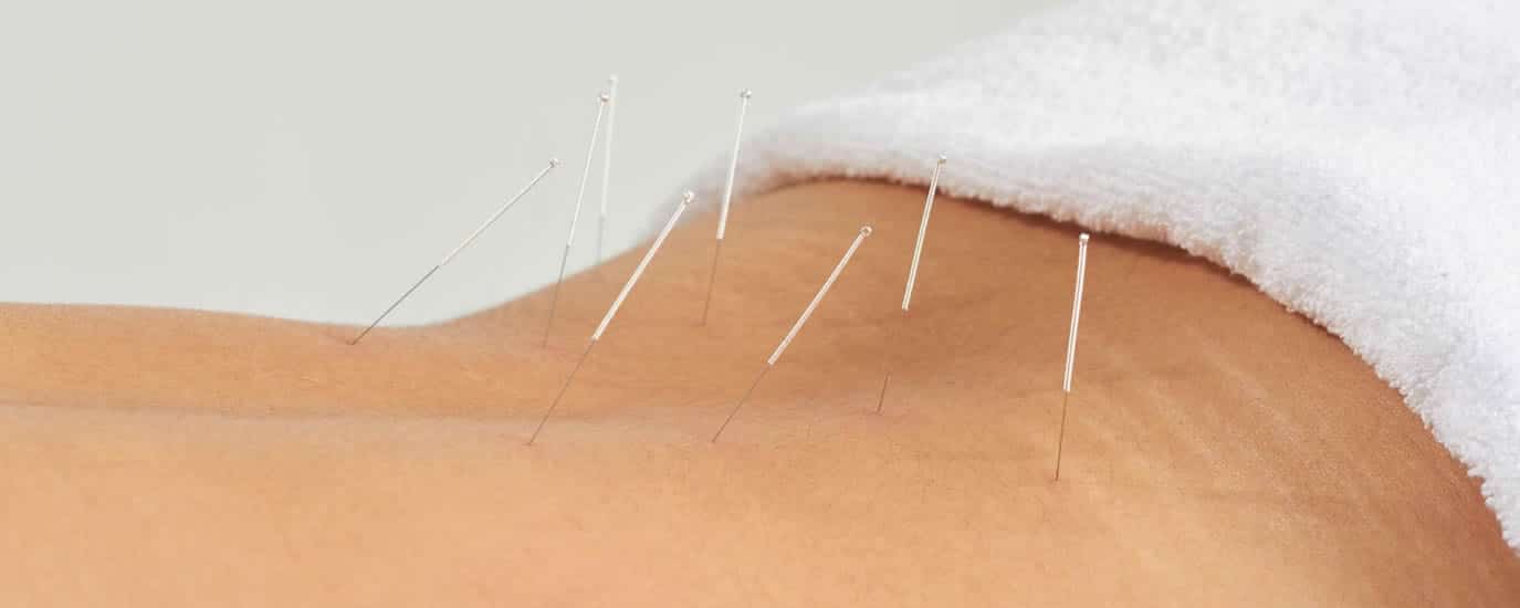 Long Island Acupuncture Treatment